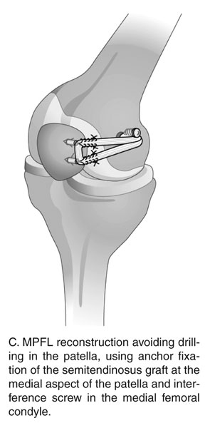 Reconstructed/Donor MPFL Ligament