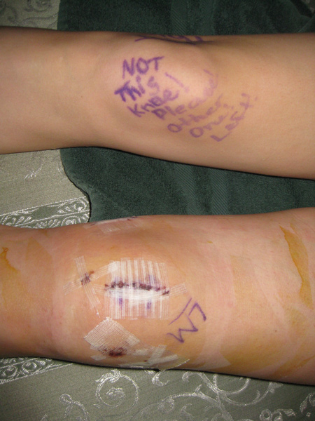 Sports Girl's Knee 5 Days Post-Op